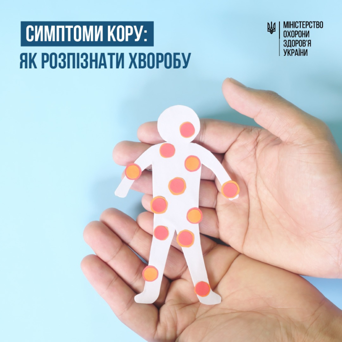 Симптоми кору: як розпізнати хворобу0