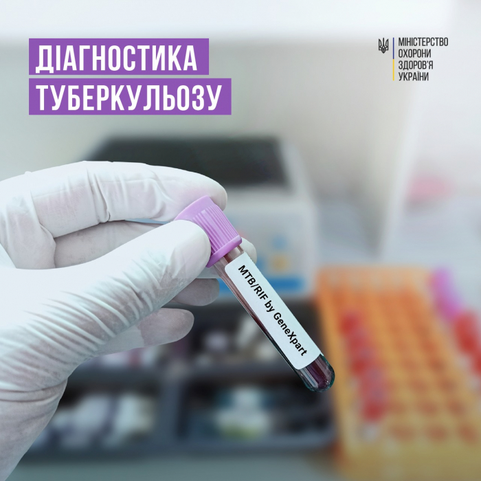 МОЗ інформує: Діагностика туберкульозу0