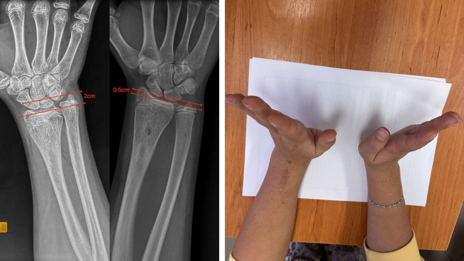 Закарпатські лікарі відновили ріст кістки 12-річній пацієнтці без складної операції0